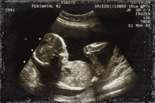 StandUpGirl ultrasound picture of baby