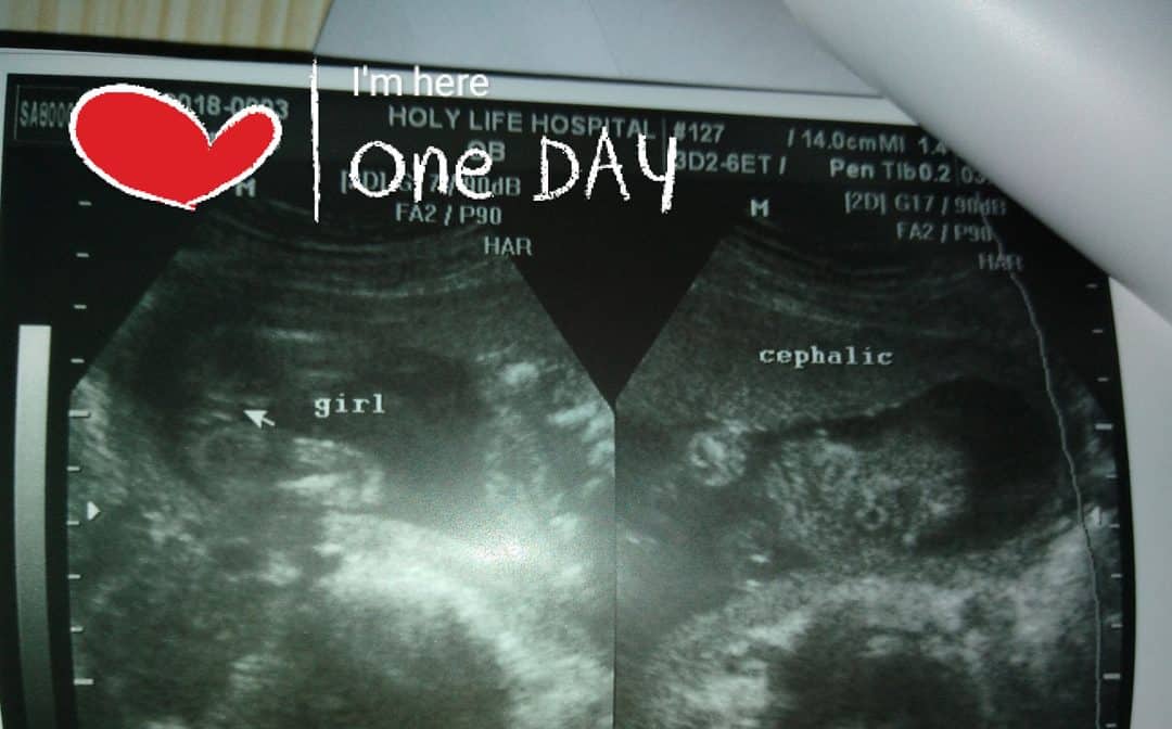 baby girl ultrasound